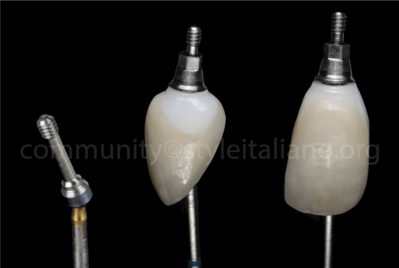 Điều Trị Lại Một Mão Răng Trên Implant: Tối ưu hoá kết quả bằng phần mềm OptiShade